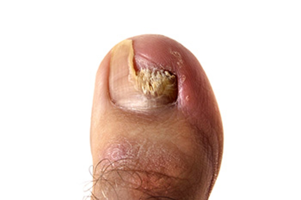 Dark Vertical Toenail Streaks Linked to Infection