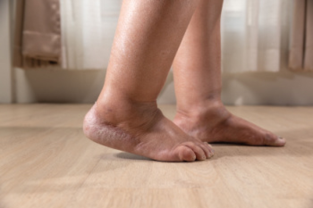 When Swollen Feet Signal a Bigger Problem