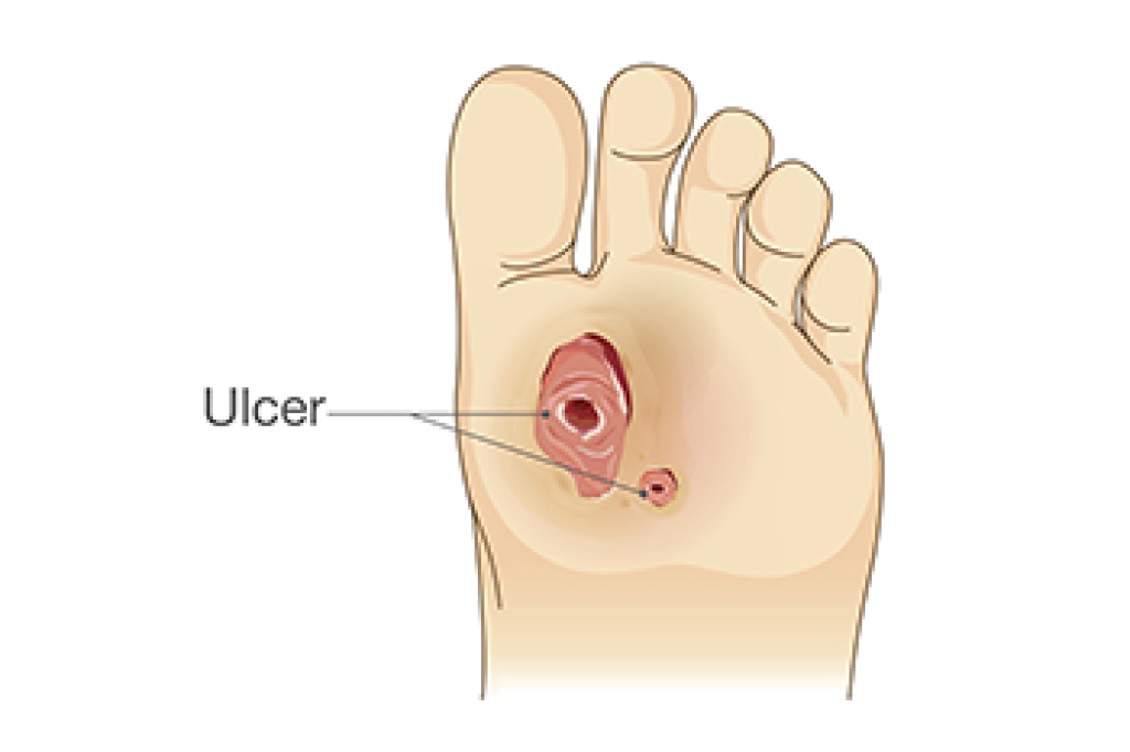 Diagnosing Diabetic Foot Ulcers Early