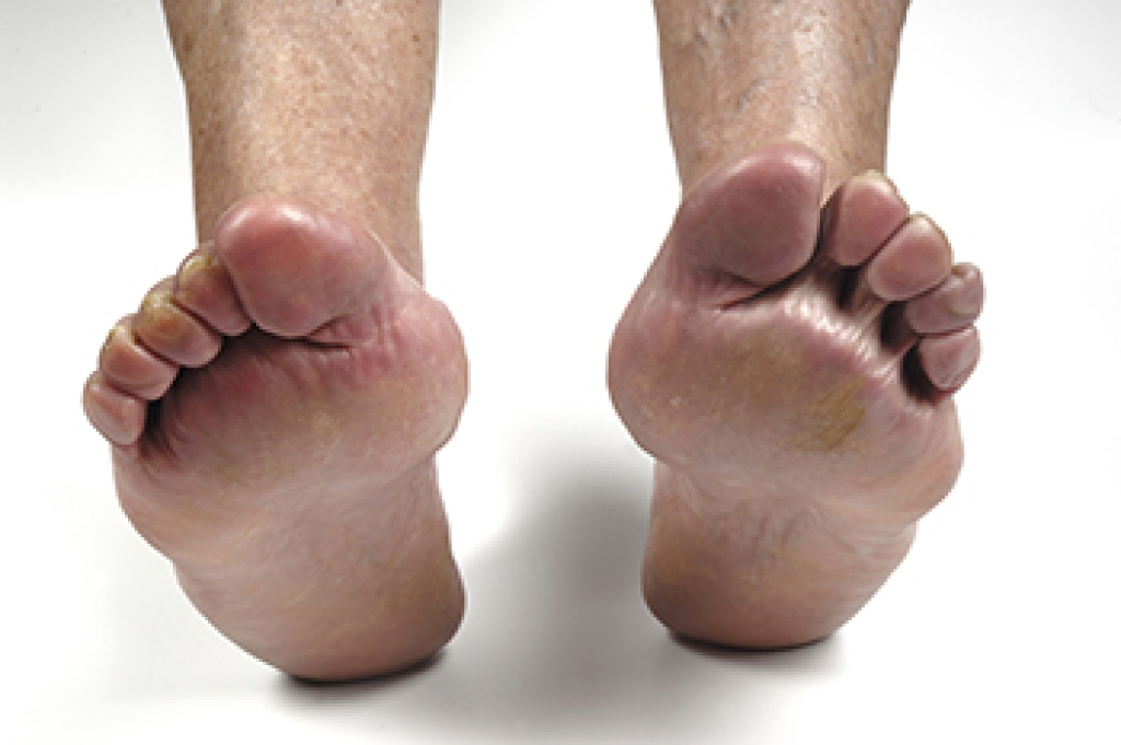 Foot Pain May Be Linked to Rheumatoid Arthritis