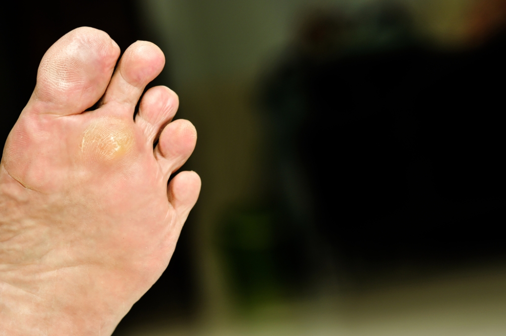 Treating Plantar Warts for Healthy Feet