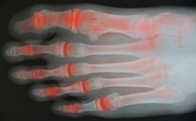 Managing Flare-Ups of Foot Arthritis