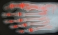 Managing Flare-Ups of Foot Arthritis