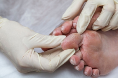 Diabetic Foot Complications