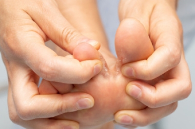 Complications From Athlete’s Foot Blisters